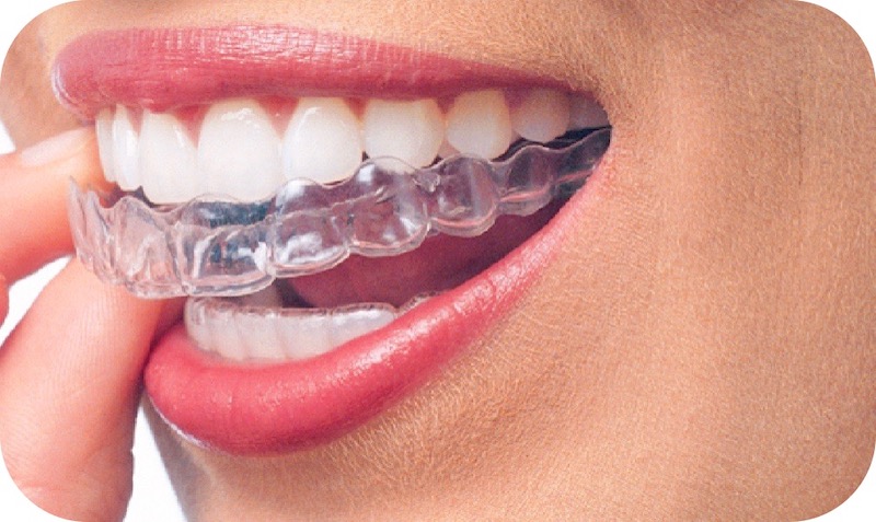 The benefits of space maintainers and clear braces in preventing dental  issues